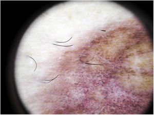 Dermoscopic features of lichen aureus. Brownish-red background with gray dots and a pigmented pseudo-network.