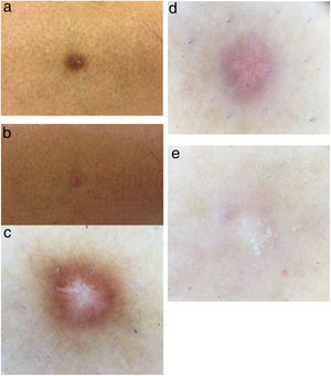 A, Dermatofibroma before treatment; B, Dermatofibroma after treatment; C, Before treatment, the dermatofibroma shows peripheral pigmentation accompanied by a white central patch; D, After treatment with the Q-Switched alexandrite laser with a wavelength of 755 nm, dermatoscopy of the dermatofibroma shows vascular structures and a white central patch; E, After treatment with the 595-nm pulsed dye laser, dermatoscopy of the dermatofibroma shows a white central patch.