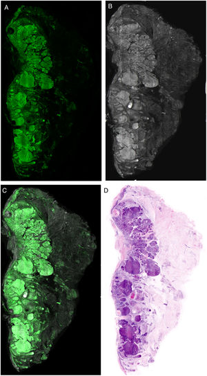 Characteristics of basal cell carcinoma in different modes: A, fluorescence; B, reflectance; C, fusion; D, digital hematoxylin–eosin.