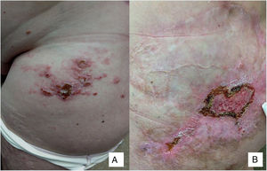 A, Confluent erythematous nodules and papules on the groin and anterior aspect of the left thigh. B, Nodules and ulcerated area (diameter, 4-5  cm) with hyperkeratotic borders inside a cicatricial plaque.