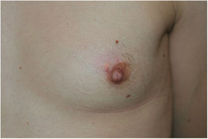 Clinical improvement 3 months after intralesional infiltration with triamcinolone.