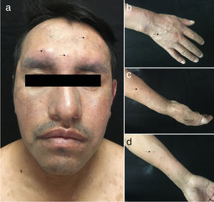Clinical image of the new lesions. Violaceous, infiltrated papules, some of which are excoriated and crusted, on the face (A) and distal area of the upper limbs (B-D).