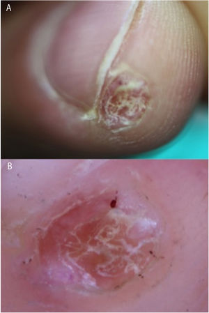A) The hyperkeratotic lesion on the pulp of the finger. B) Dermoscopic image showing hemorrhagic areas and hyperkeratosis against a pinkish-orange background.