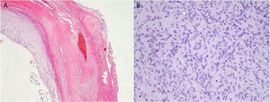 A) Hemorrhagic areas in the stratum corneum of the epidermis. Hematoxylin-eosin (HE) ×20. B) Perivascular myoid cells can be observed in the center. HE ×40.