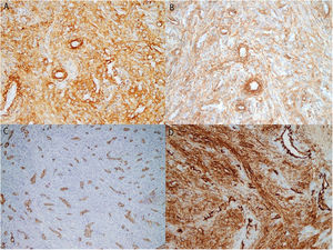Immunohistochemistry staining positive for A) caldesmon (×40), B) actin (×40), C) CD31 (×20), and D) CD34 (×40). C and D also show myoid cells arranged concentrically around endothelial cells.