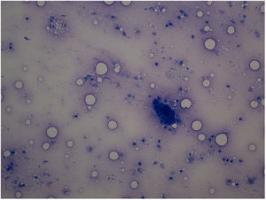 Malignant epithelial cells. Fine-needle aspiration smear (Giemsa staining).