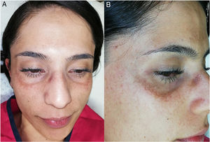 A, Bilateral, symmetrical lesions in the infraorbital region. B, Higher-magnification image showing speckled, grayish-brown macules coalescing to form a plaque.
