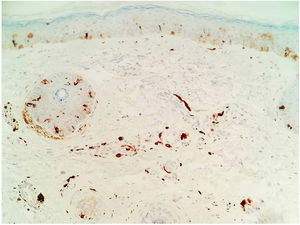 Dermal spindle melanocytes located between collagen and perivascular fibers (S100 staining, original magnification ×20).