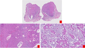 A, Panoramic image showing a dermal tumor with well-defined borders and mild peripheral retraction (hematoxylin-eosin [HE], original magnification ×10). B, Higher magnification image showing cuboidal cells with eosinophilic cytoplasm and without cytological atypia, arranged in strands forming tubular structures (HE, original magnification ×20). C, ocally, the stroma has a chondroid and myxoid appearance (HE, original magnification ×40).