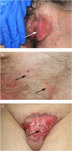 A, Clinical appearance of extramammary Paget disease (EMPD) on the left labium majus. B, EMPD involving the pubis and inguinal region with 2 areas separated by apparently healthy skin. C, Tumor lesion on long-standing EMPD on the pubis.