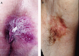 A, Clinical appearance of extramammary Paget disease (EMPD) in the perianal region. B, Axillary EMPD.