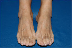 Skin-colored papules and nodules compatible with neurofibromas on the front of the legs and on the feet.