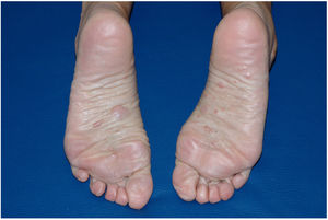 Skin-colored papules and nodules compatible with neurofibromas on the soles of both feet.