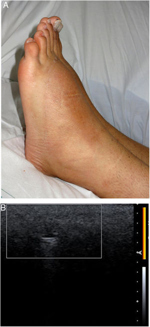 A, Significant increase in volume on the dorsal aspect of both feet of patient 1. B, Color Doppler ultrasound (18-MHz probe) in patient 1 reveals a small anechoic pseudocyst with posterior reinforcement, no increase in vascularization, and a snowstorm-like pattern.