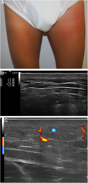 A, Erythematous edematous plaque on the left thigh of patient 5. B, Numerous hypoechoic or anechoic pseudocysts in subcutaneous tissue in patient 5 (B-mode ultrasound with 18-MHz probe). C, Increased vascularization in patient 5 (color Doppler ultrasound with 18-MHz probe).