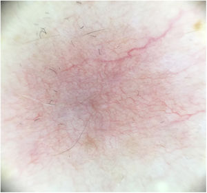 Dermatoscopy showing a fine telangiectatic network and poorly-defined blue-grey area.