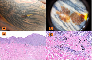 A, Pigmented lesion with abnormal ABCD clinical criteria on the right arm over a tattoo. B, Dermatoscopy (DermLite® DL3) ×10: Melanoma lesion with areas of regression, broken and atypical pigmented network, asymmetry and manifest polychromasia, confirmed histologically as superficial-spreading melanoma, Breslow depth 0.25 mm. C, H&E, ×2: Low-magnification view of superficial-spreading melanoma with pagetoid distribution. D, Melan A: Detail of melanoma staining and pigment in the superficial dermis.