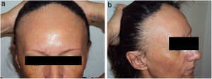 Premenopausal woman with frontal fibrosing alopecia. A, Frontal view. B, Lateral view (note the presence of facial papules).