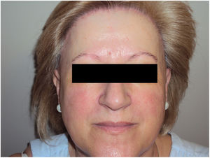 Woman with frontal fibrosing alopecia and signs of rosacea.