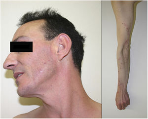 Excoriation on an erythematous base in the cervicofacial area.