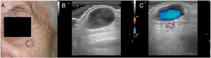 CASE 1. (A) Clinical image: bluish nodule located on the left cheek. (B) US image. B-mode: Subdermal heterogenic hypoechoic cystic lesion. (C) US image. Color-Doppler: turbulent color Doppler flow.