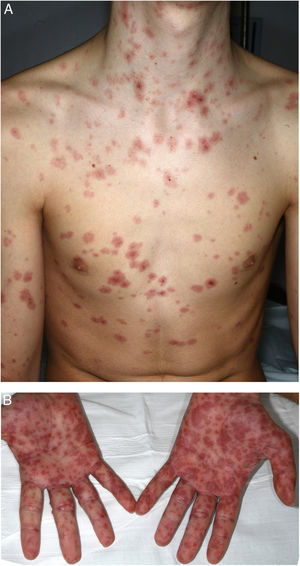Stevens-Johnson syndrome. Multiple erythematous target-like macules on the trunk (A) and the palms (B).