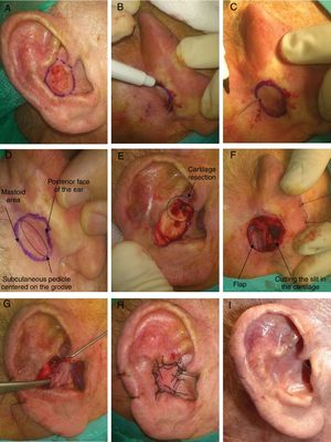 A, 80-year-old man with squamous cell carcinoma measuring 1.5 cm in the right concha of auricle. Delimitation of the resection margin. B and C, Design of the flap in the retroauricular area. To mark out the flap, a needle can be passed through the borders of the surgical defect from the anterior face to the retroauricular area. D, Flap design. The area corresponding to the subcutaneous pedicle should be centered on the retroauricular groove. E, Tumor excision. In addition, an area of auricular cartilage should be resected to make a slit for the flap to pass through to the anterior area. F, Flap dissected at its borders, attached in its central area to the groove. G, With forceps, the flap is passed through to the anterior part of the ear. H, Flap suture with 3/0 silk thread. I, Outcome 4 months after surgery.
