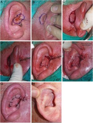 A, 85-year-old man with basal cell carcinoma measuring 1.5 cm in the right superior concha and root of the helix. B, Design of RDIF. C, The flap incision should be deep and vertical towards the periosteum in the mastoid area and towards the perichondrium in the posterior face of the ear. D-F, The flap is made with a 90° rotation towards the anterior area, passing through the cartilage. G, Direct closure is performed in the defect in the root of the helix, whereas the flap is sutured in the concha. H, Outcome 2 months after surgery.