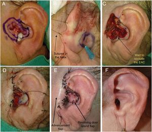A, 70-year-old woman with a complex basal cell carcinoma measuring 2.5 cm in diameter, affecting 4 areas (concha, root of the helix, tragus, and preauricular area). B, Design of RDIF. Placement of long sutures in the helix allows the auricle to be pulled forward to improve visualization of the surgical field. C, Resected tumor. D and E, The tragus, root of the helix, and preauricular areas are reconstructed with an advancement flap, whereas a revolving door island flap is used for the concha of auricle. F, Outcome 8 months after surgery. There had been no recurrences after 8 years of follow-up.