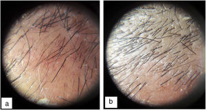 Dermatoscopy image of a patient with androgenetic alopecia. A, Before the intervention (198 hairs/cm2). B, After 2 months (308 hairs/cm2).