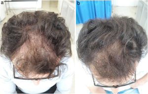 Clinical image of a patient with androgenetic alopecia. A, Before treatment. B, At 6 months after the first platelet rich plasma injection.