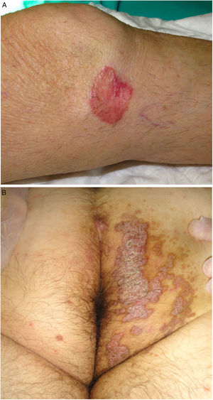 A, Porokeratosis of Mibelli. Round, erythematous plaque measuring 4cm with a raised hyperkeratotic border on the left knee. Diagnosis was confirmed by histology. B, Porokeratosis ptychotropica. Multiple coalescent erythematous scaling plaques with a hyperkeratotic edge in the perianal area and on the right buttock.