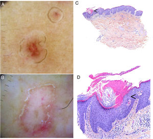 Porokeratosis. A–B, Dermoscopy. Erythematous brownish lesion without clearly defined structures and with a brownish annular border (A). Lesion with structureless white areas and dotted vessels and a hyperkeratotic annular border. Note the double-track sign (B) (Gen Dermlite DL200, ×8). C–D. Histology. Epidermal invagination with a parakeratotic column (cornoid lamella) (arrow)) (hematoxylin–eosin, original magnification ×40) (C). Cornoid lamella (D). Note the loss of the granular layer underlying the parakeratotic column (arrow) and the keratinocytes in the stratum spinosum (hematoxylin–eosin, original magnification ×200). Cornoid lamella (arrow) (hematoxylin–eosin, ×100).