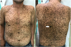 A, Marked generalized lentiginosis affecting the trunk and extremities. Note the lentigines that are smaller than 1cm and café noir spots >1cm. B, A recent intensely pigmented lesion can be seen on the left dorsal area (arrow).