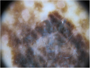 Dermoscopic image showing the atypical pigmented network and gray-blue areas.