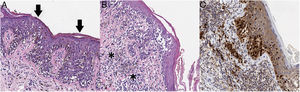 A, The histopathology analysis reveals an atypical melanocytic neoplasm with a lentiginous growth pattern, pagetoid spread (arrows), and a moth-eaten pattern in the epidermis (hematoxylin-eosin, ×200). B, In other areas, we can see atypical melanocytes infiltrating the most superficial part of the dermis (asterisk), together with fibroplasia of the papillary dermis and inflammatory infiltrate (hematoxylin-eosin, ×200). C, Immunohistochemistry reveals nuclear positivity in intradermal and intraepidermal melanocytes (Sox10, ×200).