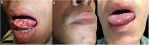 A, Tongue ulcer. B, Molluscoid pearly papules on the upper lip. C, Re-epithelialized lesion after treatment.