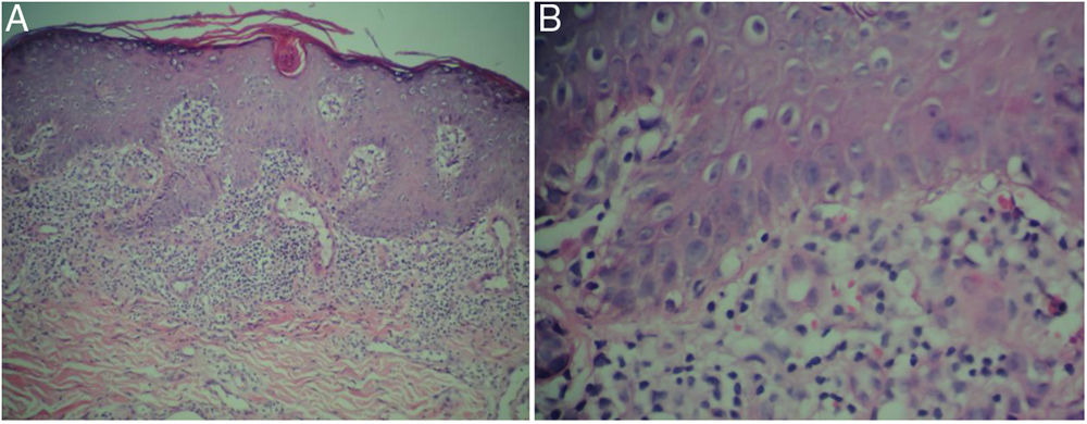 Confluent, Retiform, Violaceous Hyperkeratotic Papules | Actas Dermo ...