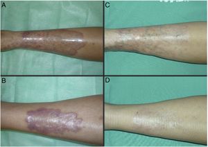 Case 1. A 21-year-old woman with DM1 and necrobiosis lipoidica with a long time since onset (72 months). Appearance of the lesions at the start (A and B) and after completing treatment with conventional PDT with MAL (C and D). gr1.