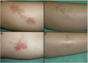 Case 2. A 32-year-old woman with DM1 and necrobiosis lipoidica with less time since onset (8 months). Appearance of the lesions at the start (A and B) and after completing treatment with conventional PDT with MAL (C and D). gr2.