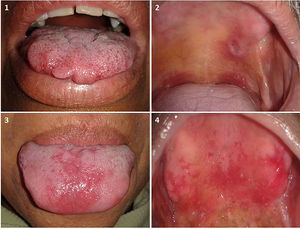 Lesions unrelated to leprosy. A, Traumatic fibroma on the tongue. B, Traumatic ulcer on the palate. C, Erythematous candidiasis on the tongue. D, Prosthetic stomatitis on the palate.