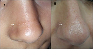 A, Transverse nasal line in our patient. B, Transverse nasal line in the patient’s mother.