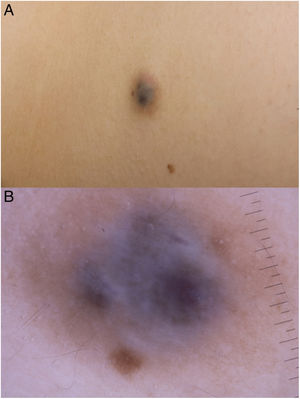 A, Clinical image of the lumbar lesion. B, Dermatoscopic image.