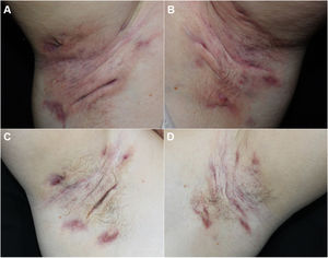A and B, Left and right axillae with nodules and suppurative fistulas prior to treatment. C and D, Left and right axillae with residual lesions after 4 months of treatment with secukinumab, 300 mg.