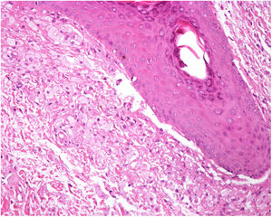 Accumulation of foam cells adjacent to a hair follicle.
