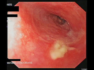 Esophagogastroduodenoscopy. Friable esophageal mucosa with erosions and strictures.