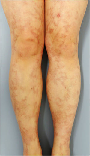 Infiltrative brownish erythema and livedo racemosa on the bilateral lower legs.