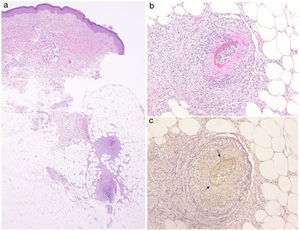 (a) Histological features showing necrotizing vasculitis in the subcutis. (b) Higher magnification revealed subintimal fibrinoid necrosis. (c) Partially disrupted internal elastic lamina (arrow) (Elastica van Gieson stain).
