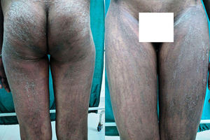 Flagellate erythema and linear papules with scales showing Koebner's phenomenon over buttocks (left panel) and thighs (right panel).