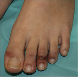 Acral pseudochilblain papule.